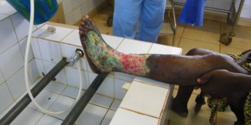 CAMPAGNE GRATUITE DE LUTTE CONTRE L’ULCÈRE DE BURULI : Le Ministre de la Santé lance un appel à la mobilisation